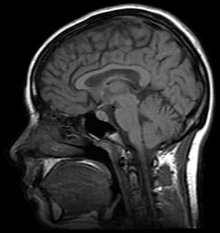 MRI image of a human head